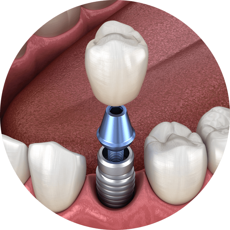 Another Model of Dental Implants