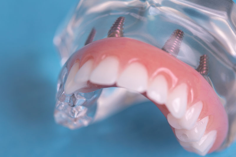 Model of Full Arch Dental Implants