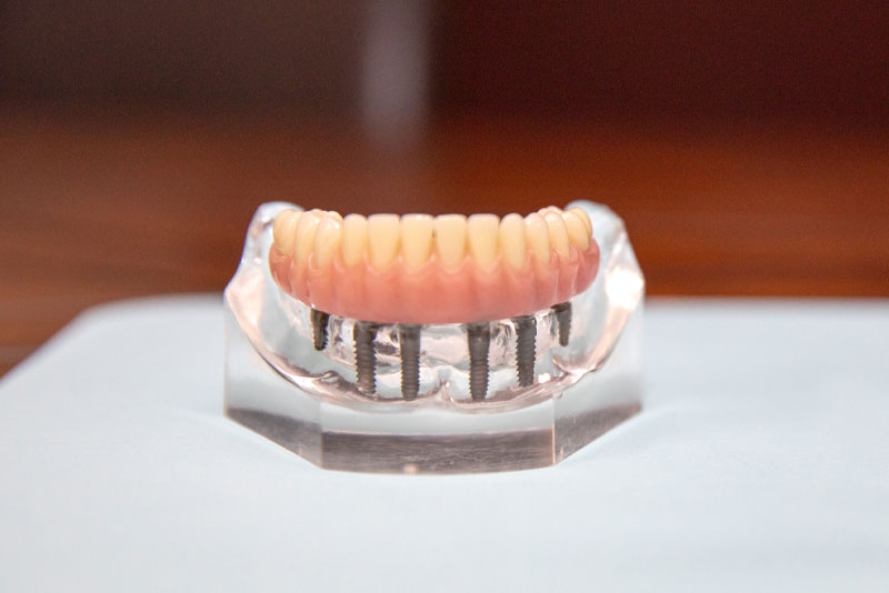 Full-Mouth Dental Implants in Elyria and Grafton, OH