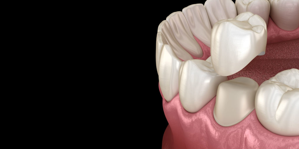 Model of Dental Crown