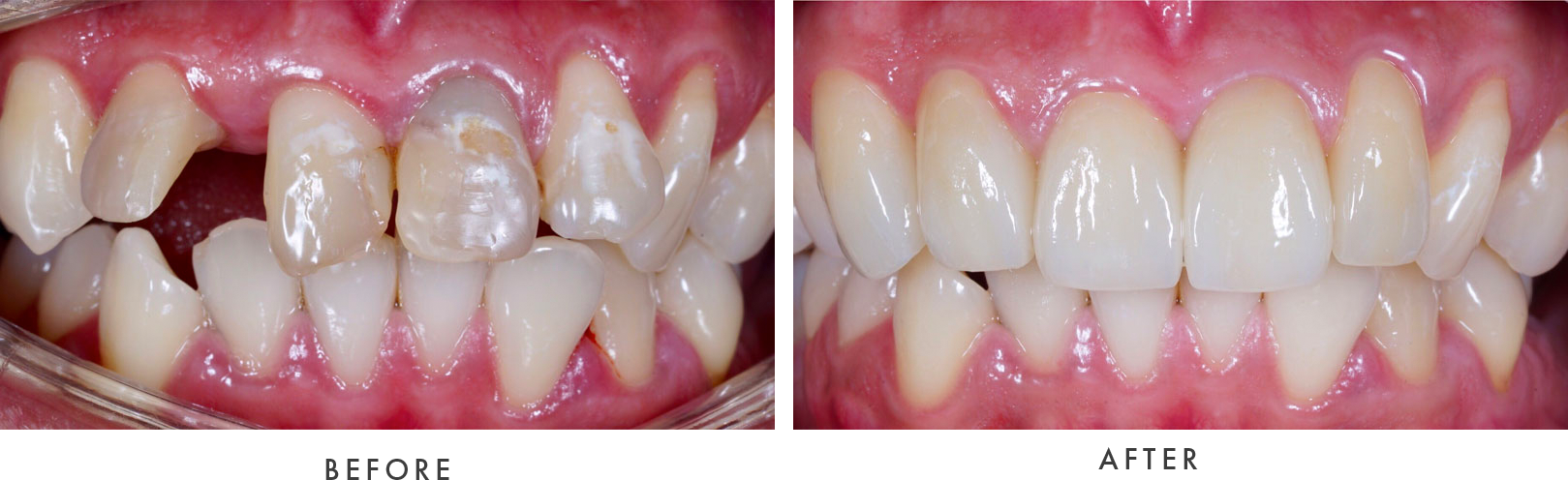 Another Before & After Example of Dental Implants