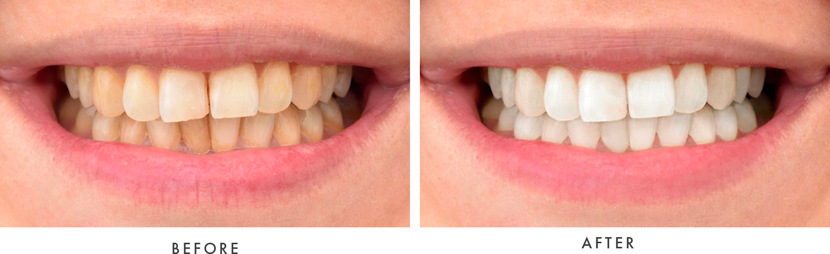 Teeth Whitening