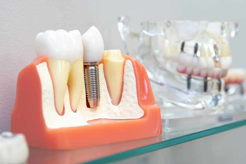 Single Dental Implants in Elyria and Grafton, OH