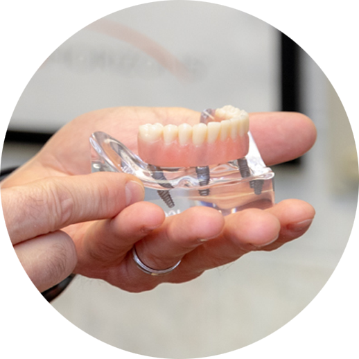 Full Mouth Implants Model
