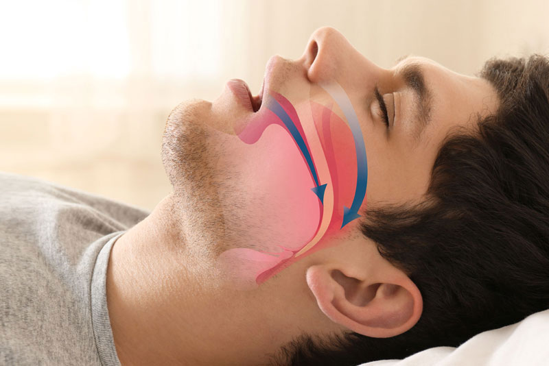 Graphic of What Sleep Apnea Looks Like